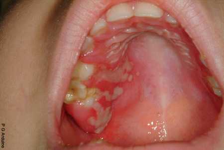Инфекции Coxiella burnetii