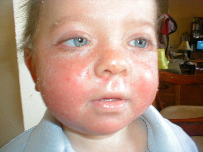 Искривления перегородки носа у детей